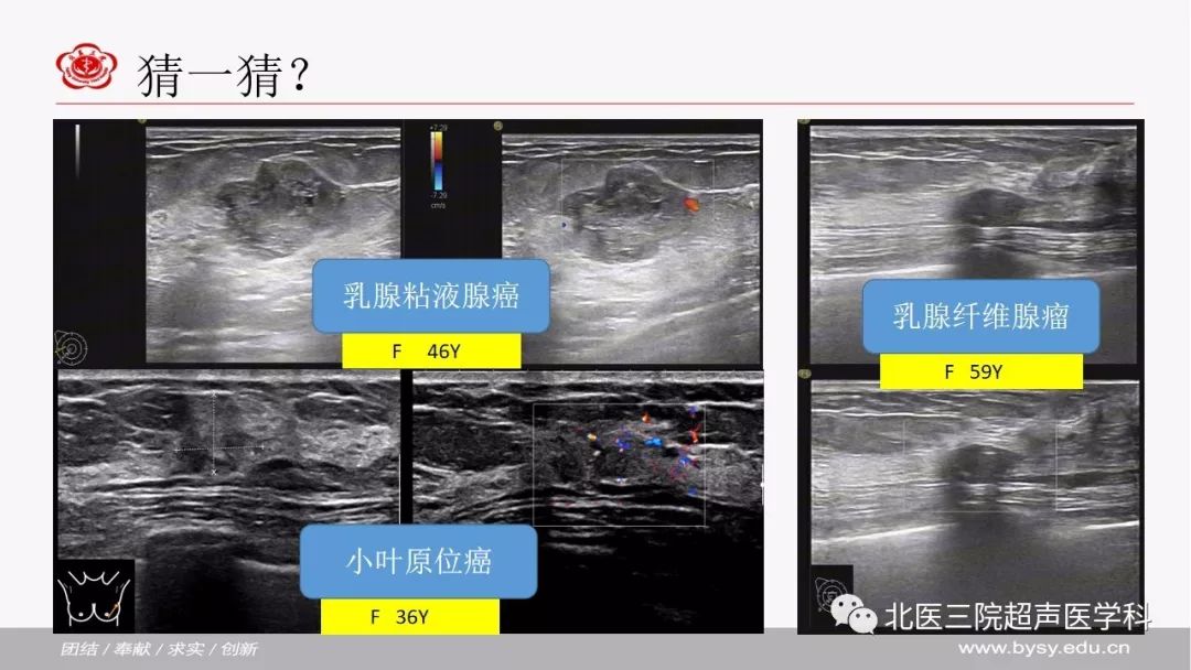 超声微课堂病例回顾与学习乳腺粘液腺癌小叶原位癌与哺乳期乳腺癌