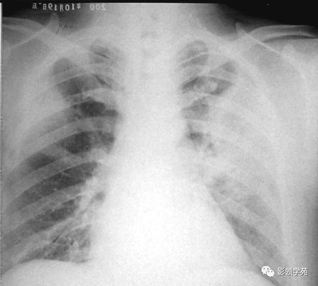 ards的典型影像表现为肺内弥漫性的肺泡实变影像.