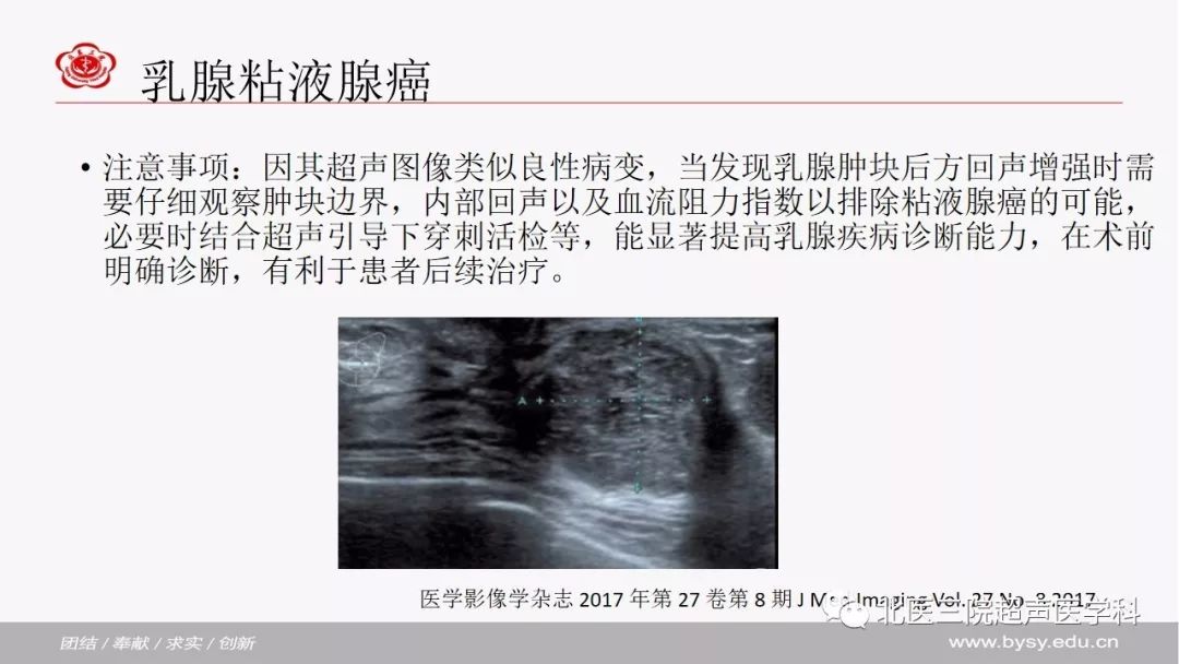 超声微课堂病例回顾与学习乳腺粘液腺癌小叶原位癌与哺乳期乳腺癌