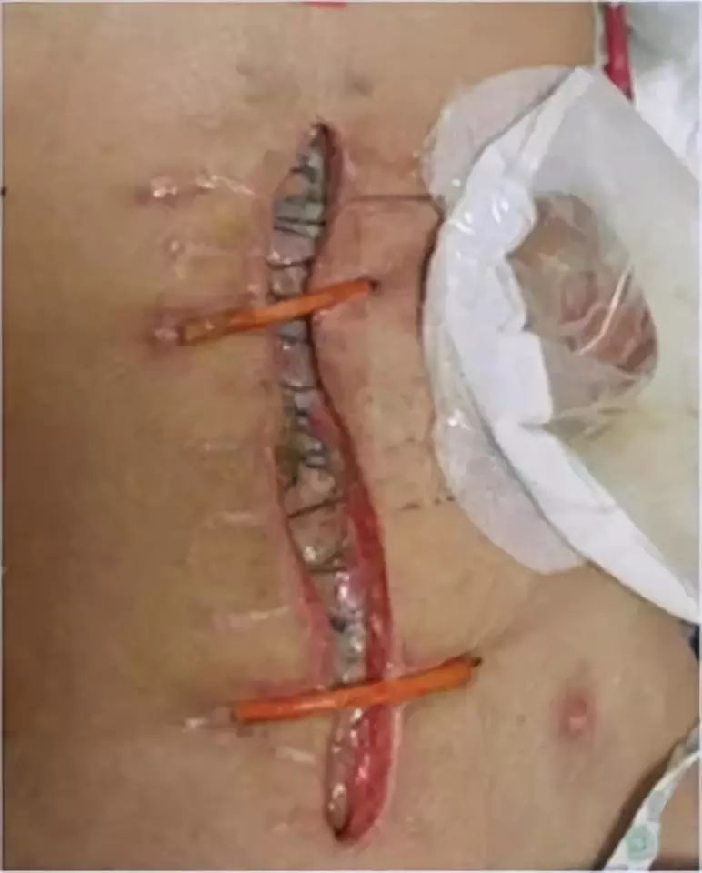 疑难伤口:结肠穿孔术后全层切口感染裂开,负压引流处理要点