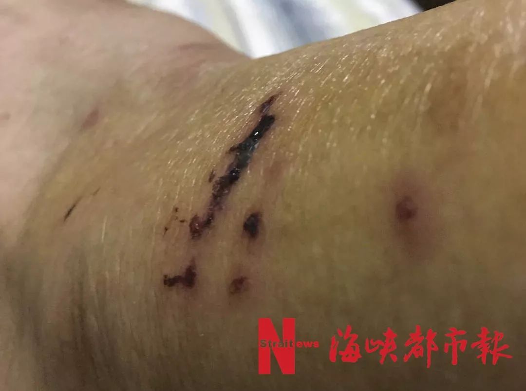 6岁女童手臂被咬烂!类似事件高发!已有人被活活咬死!
