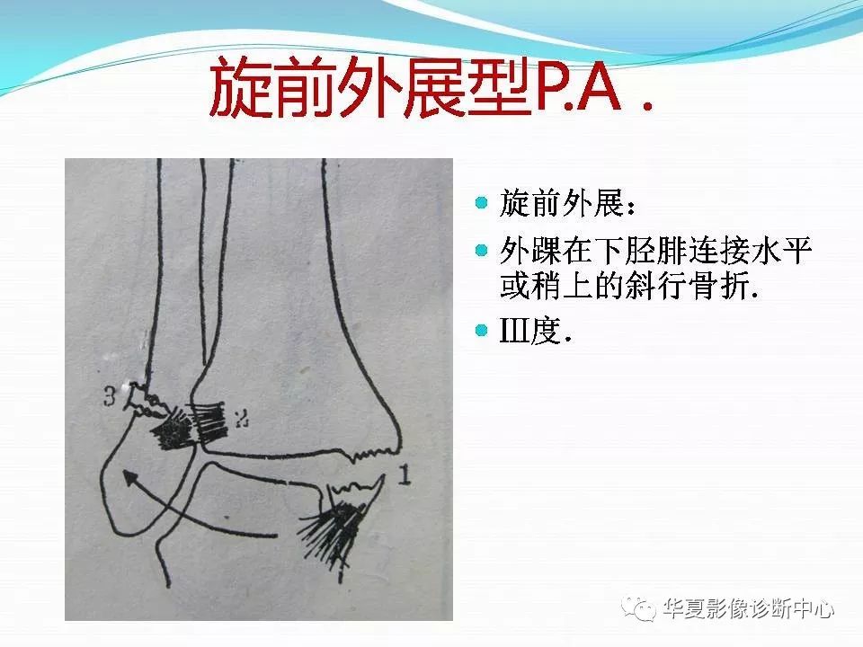 踝关节骨折的分型
