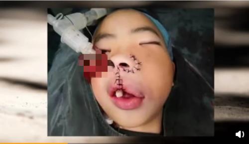                     男童患脸部肿瘤堪比“地壳运动”甚是可怖，却坚强阳光，笑面生活