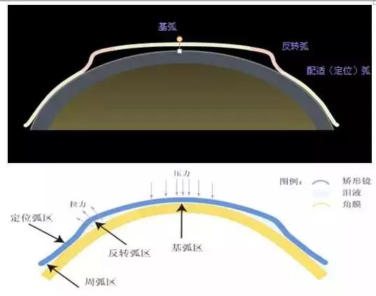 塑形镜的原理_△角膜塑形镜视力矫正原理
