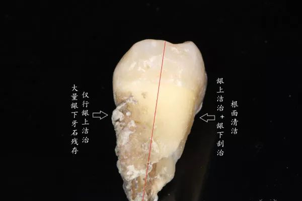 牙龈下方的牙菌斑,因为不容易刷到,再加上刷牙方式不对的话,牙龈下的