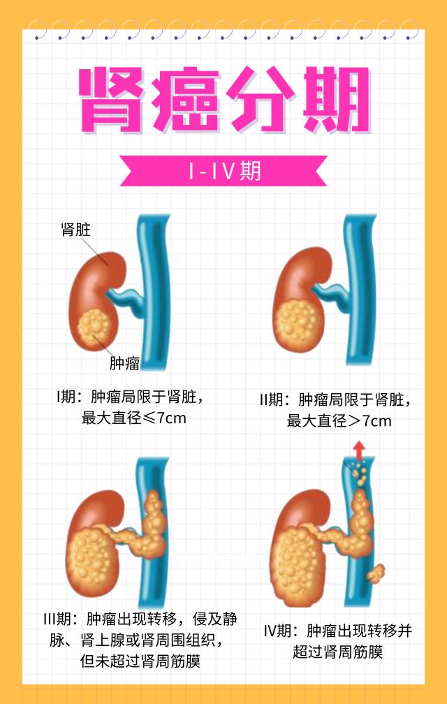 肾癌的临床分期为i~iv期,如果简单地将肾癌分为早中晚期的话,早期