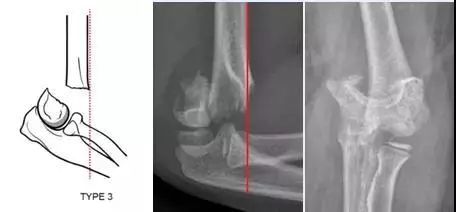 type iv:屈曲性肱骨髁上骨折,侧位片肱骨前缘线后移于肱骨小头