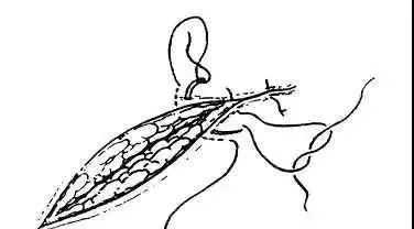 ⑵间断水平褥式外翻缝合法