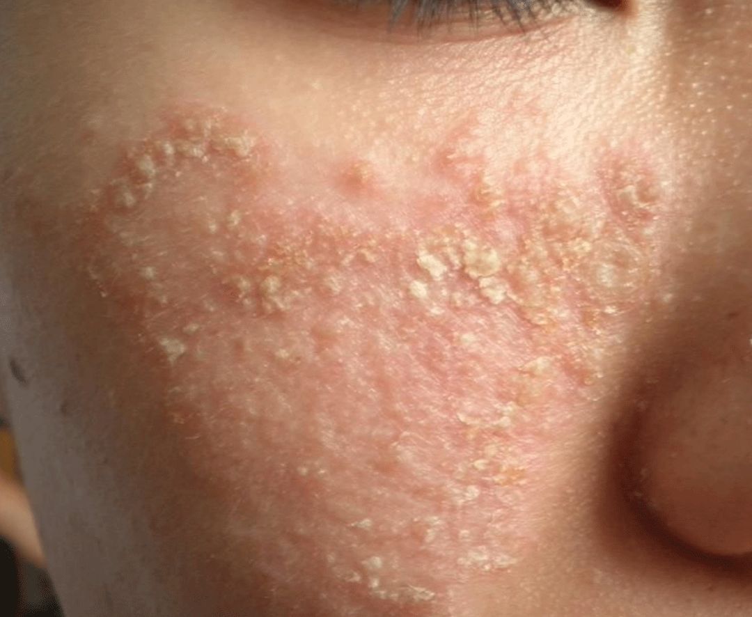 激素脸都是有哪些症状?