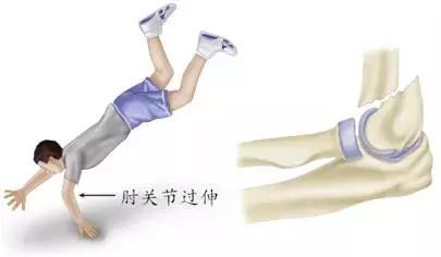 伸直型髁上骨折 跌落时肘关节屈曲形成屈曲型髁上骨折 肱骨髁上骨折的