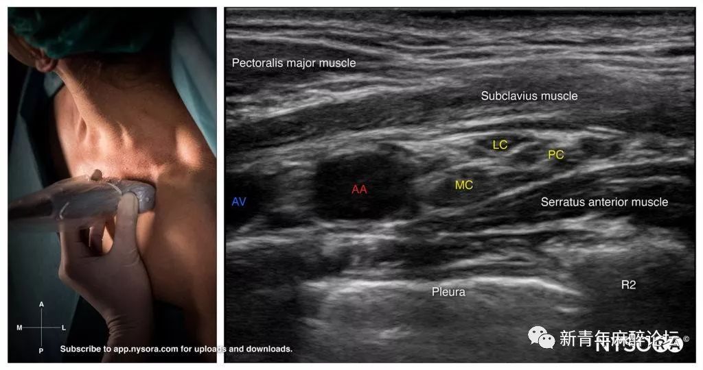 超声引导肋锁间隙臂丛神经阻滞