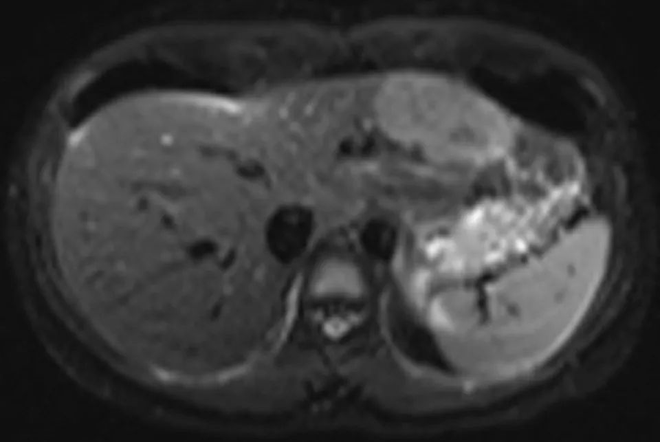 什么是动脉期边缘强化 76a4aae1240e4cd48cdc80648dbea922.jpeg