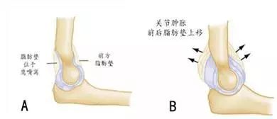 sign):肱骨髁上骨折导致肘关节肿胀继而肘关节脂肪垫上移