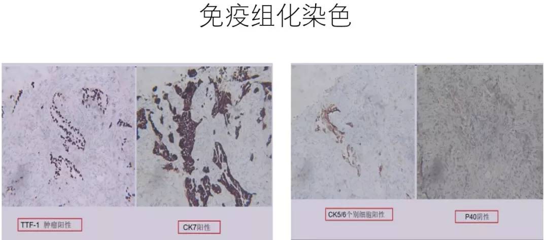 右肺浸润性腺癌,免疫组化:ttf-1( ),ck7( ),ck5/6(个别细胞 ),p40(-)