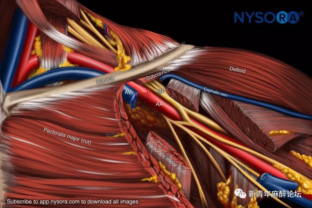 在此位置,臂丛的三束均位于腋动脉外侧,位于锁骨下肌和前锯肌之间,再