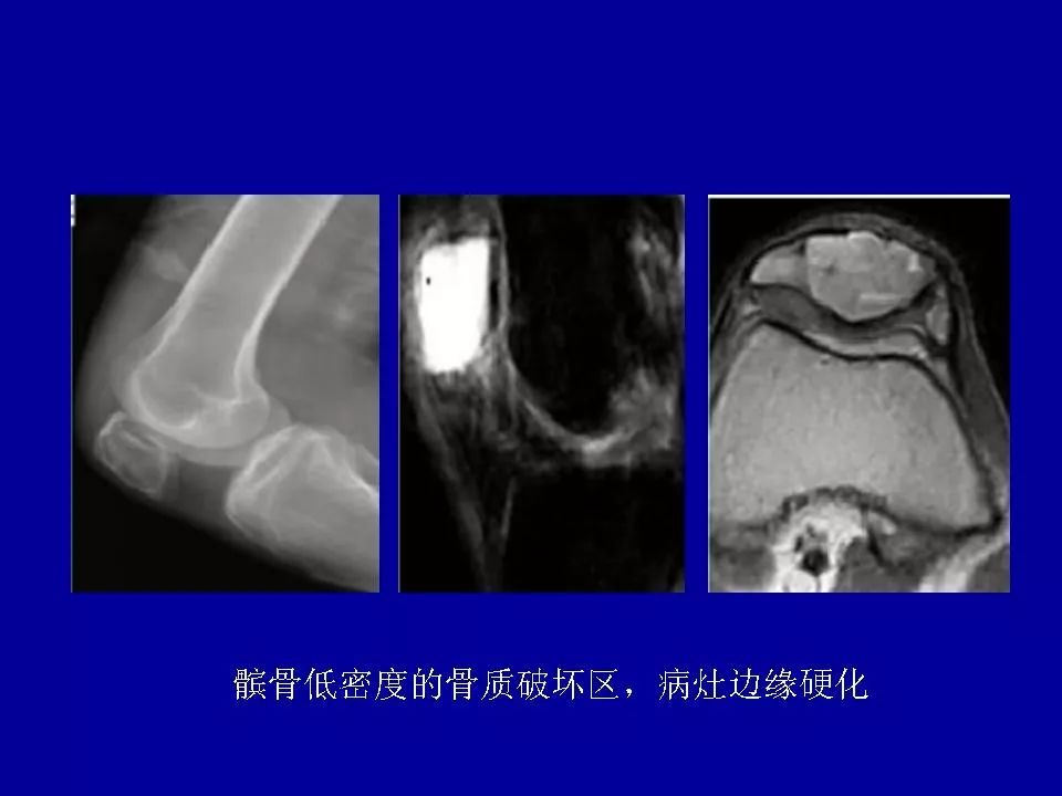 软骨母细胞瘤的影像诊断与鉴别 | 影像天地