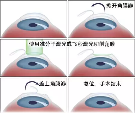 手术流程:1 用飞秒激光在基质层扫描,制作一个透镜2.