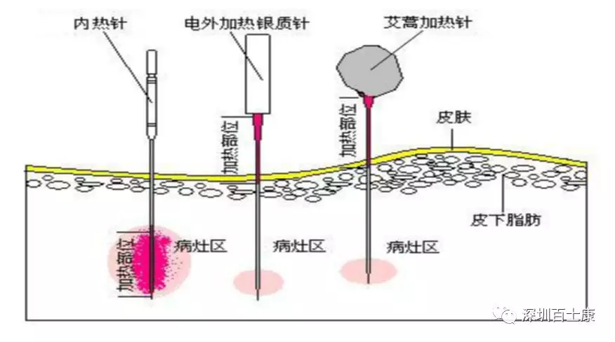 内热针的特点及消毒方法