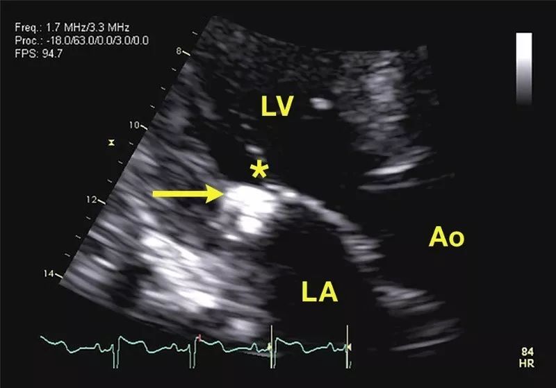 fig: 二维左心室长轴切面显示二尖瓣后瓣环钙化