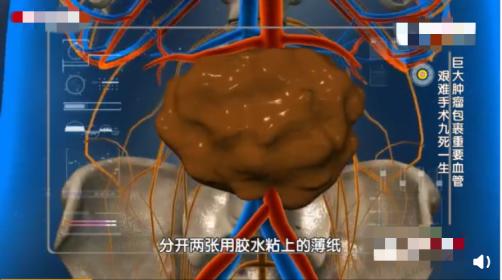                     男童患脸部肿瘤堪比“地壳运动”甚是可怖，却坚强阳光，笑面生活