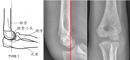 宝宝健康儿童最易出现的骨折肱骨髁上骨折是怎么回事