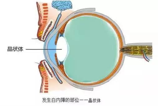 糖尿病患者为什么容易得白内障?