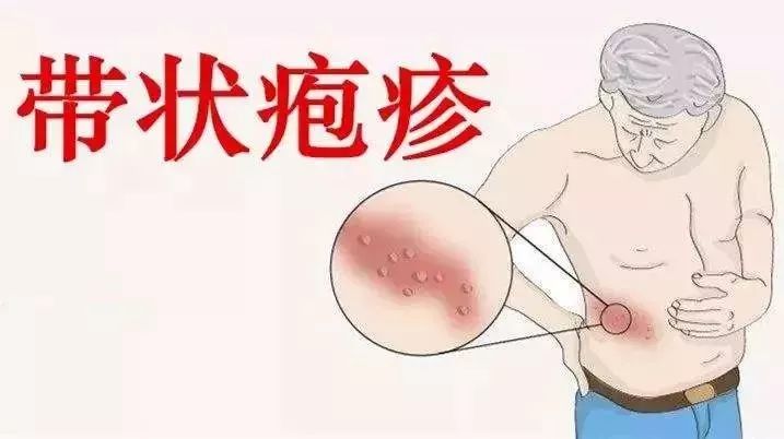 疱疹常表现为腰部周围及周身水泡型疙瘩,且瘙痒剧烈,伴有发热等症状