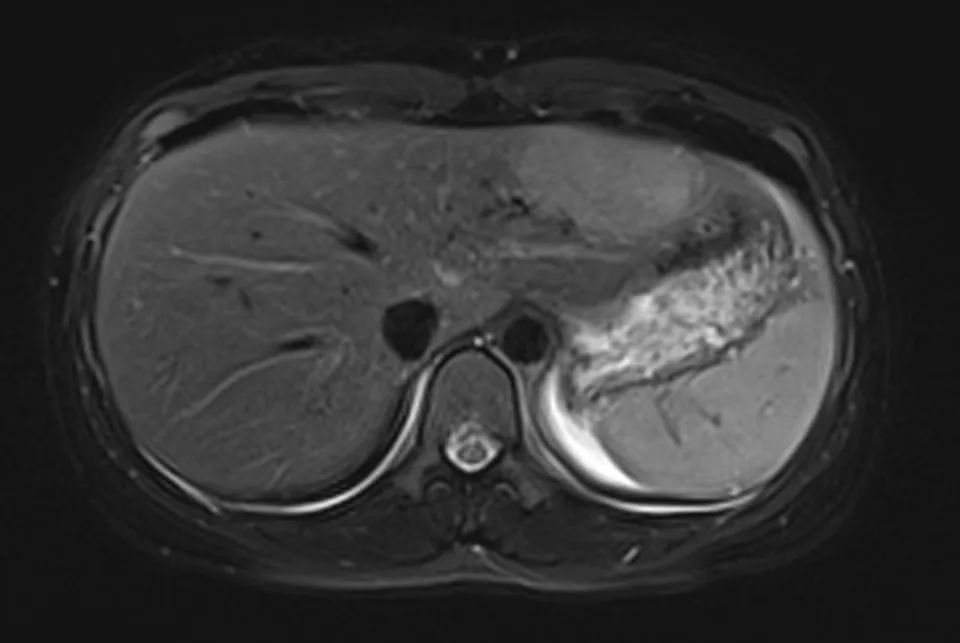 什么是动脉期边缘强化 fc63647b131947d3bcc0e730a3896fb8.jpeg