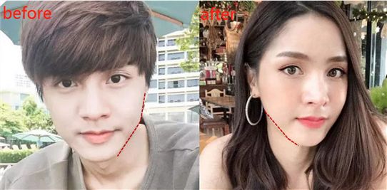 为逃兵役,韩国男子花11万变脸,经历了变性,颧骨内推,削下颌角,隆胸.