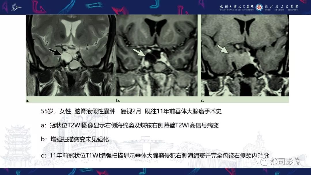 海绵窦病变临床及影像学表现(一)