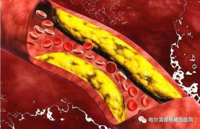 高血脂高血压,双高结伴横行,那是相当危险!