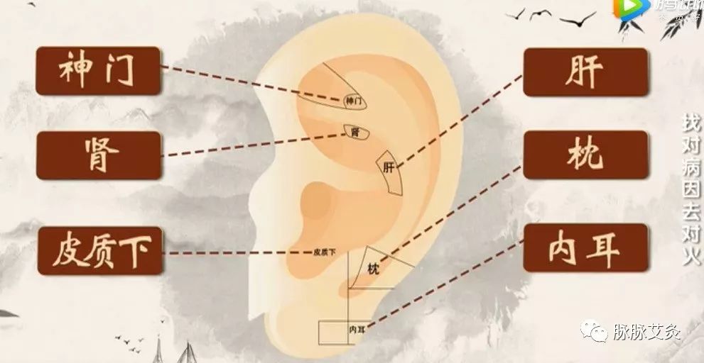 贴耳豆治疗虚火耳鸣附操作视频