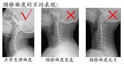 当出现颈椎曲度变得不正常时,需要及时进行治疗.