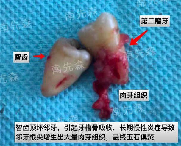 那怎么样判断自己有没有长智齿呢?