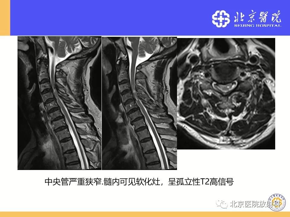 椎管狭窄的影像学检查