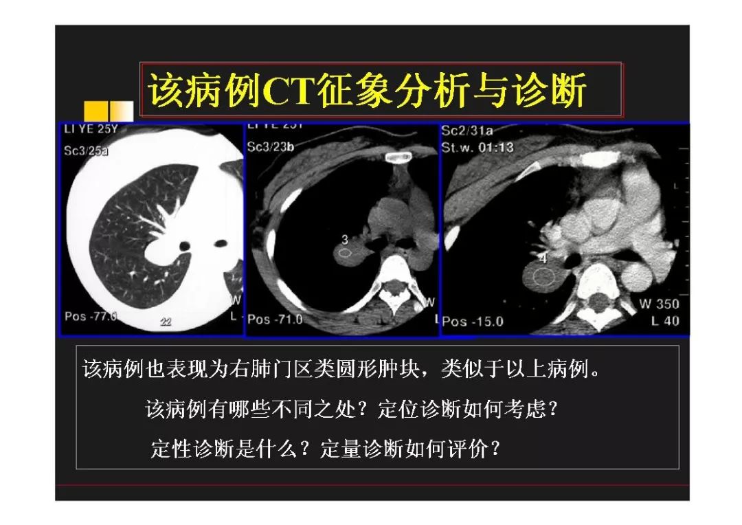 右肺门区类圆形肿物的鉴别诊断 | 影像天地