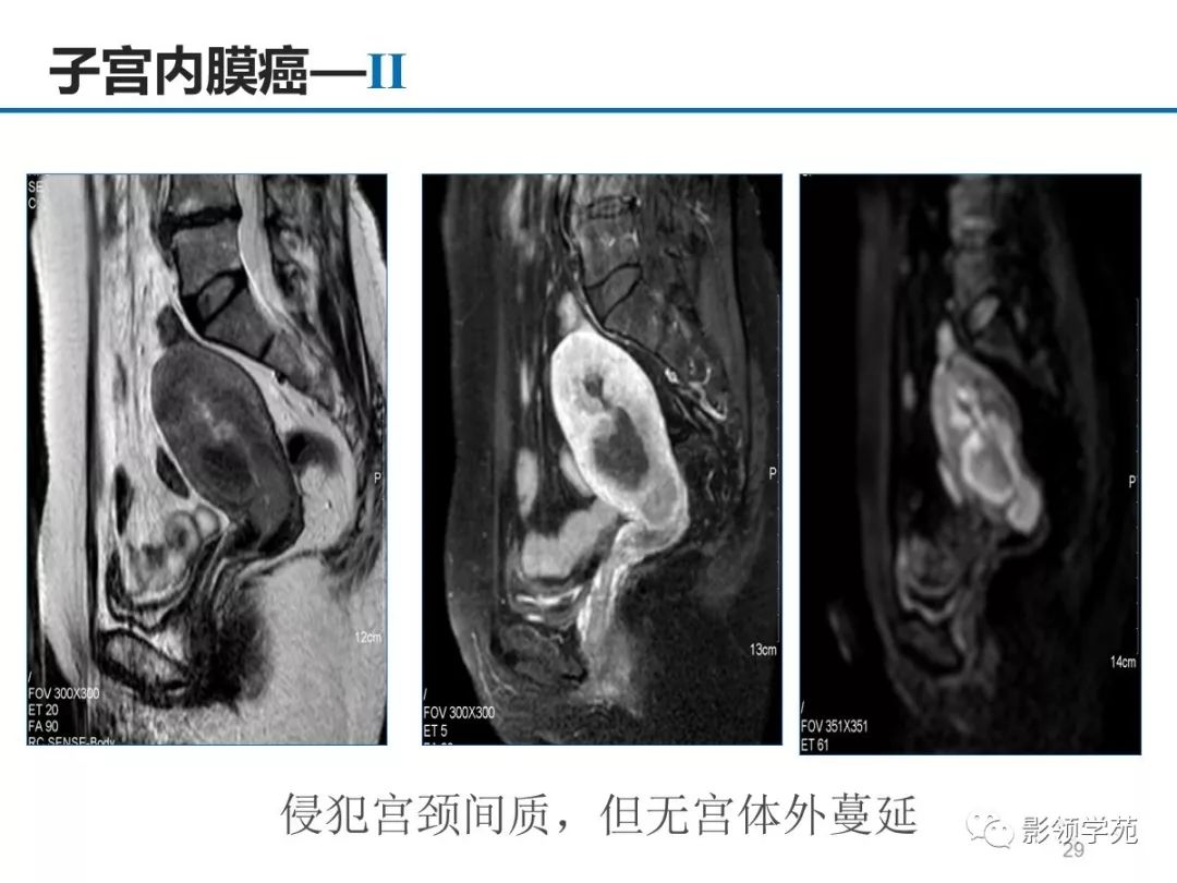 女性盆腔疾病的mri诊断