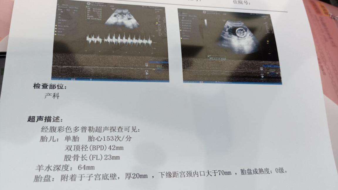                     进行胎心监护时，这一项目可能会隐藏胎儿小秘密，你了解吗？