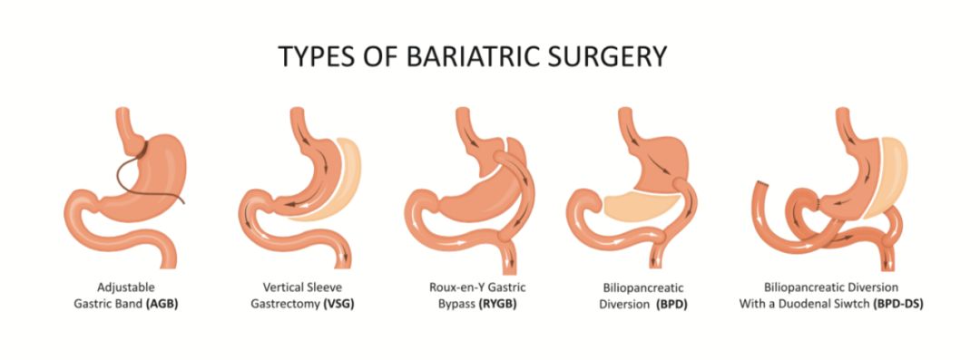 减肥手术哪种效果好_手术减肥_减肥手术有哪些方法