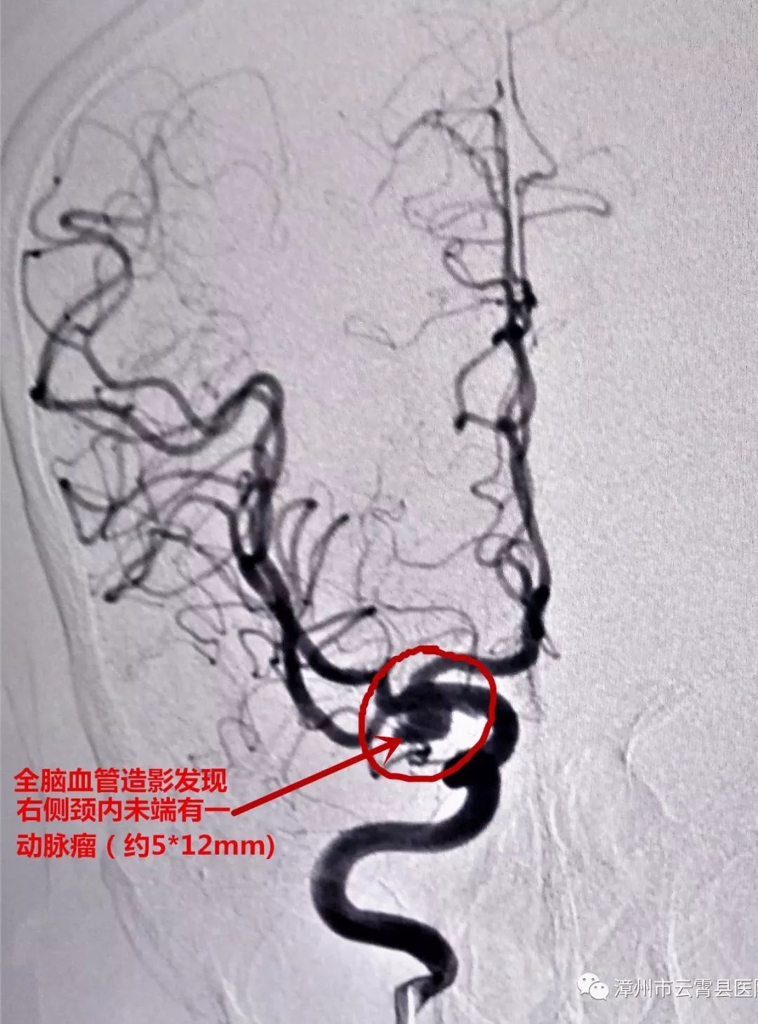 云霄县医院成功开展脑动脉瘤栓塞术