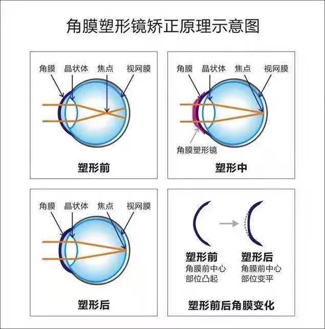 是 目前为止国内眼科专家一致认可的控制青少年近视度数增长过快的最