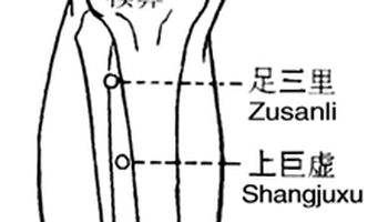 取穴:天枢,中脘,气海,上巨虚穴. 配穴:寒重者