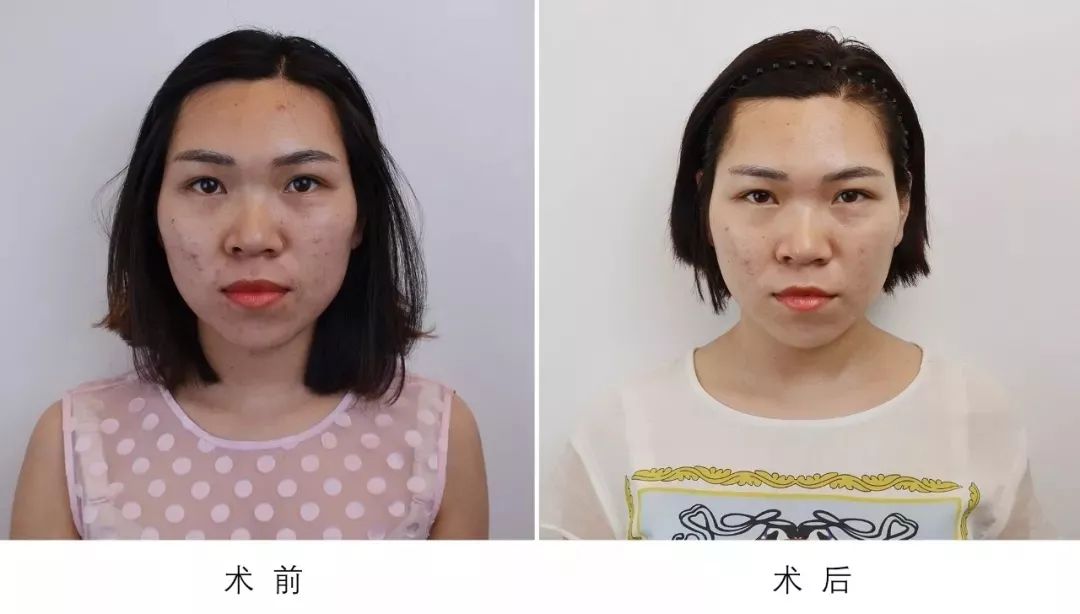 icon飞梭青春很美别因痘印追悔