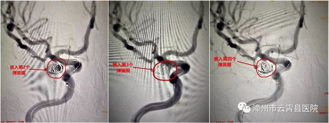 云霄县医院成功开展脑动脉瘤栓塞术