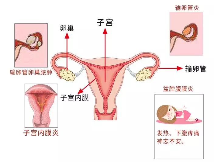 经常腰酸隐痛下腹坠胀感五洲妇儿医院大夫提醒女性朋友要警惕盆腔炎