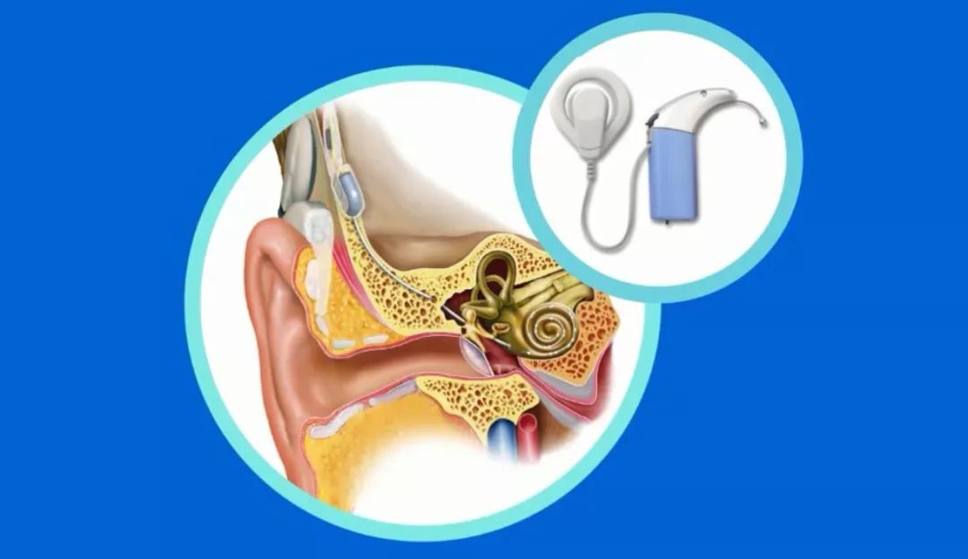人工耳蜗常识menu1人工耳蜗的组成结构:人工耳蜗由体外装置和体内