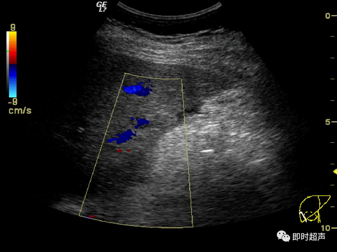 内脏损伤的超声诊断