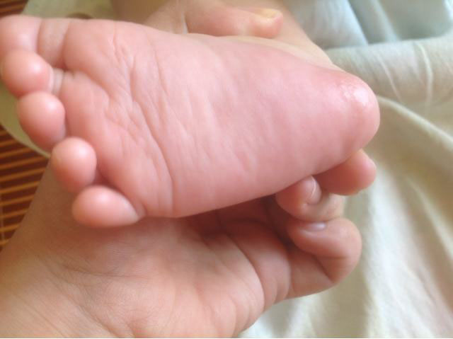                     原创            小孩子起湿疹，家长非常心疼，那么应该如何避免呢？