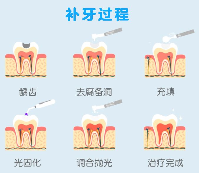 孩子补牙时要注意什么?北京五洲妇儿医院口腔科大夫来介绍