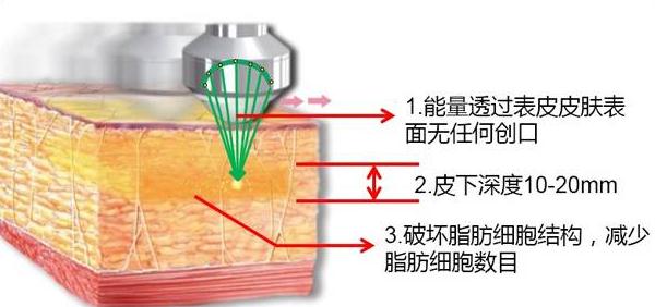 抽脂失败怎么办